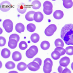 Blood Science Update | Unexpected Poor Prognosis in ZNF618::NUTM1-Positive B-ALL: A Rare Case Defies Clinical Assumptions