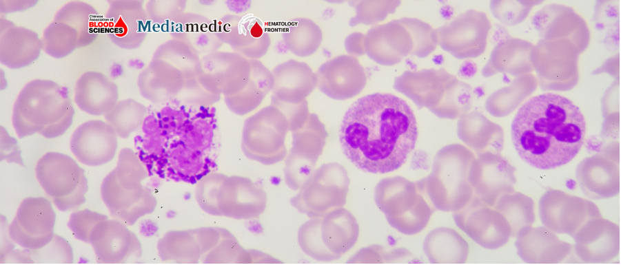 Blood Science Update|Alpha-Enolase Drives AML Progression via MAPK/ERK Signaling: Condensed Summary 